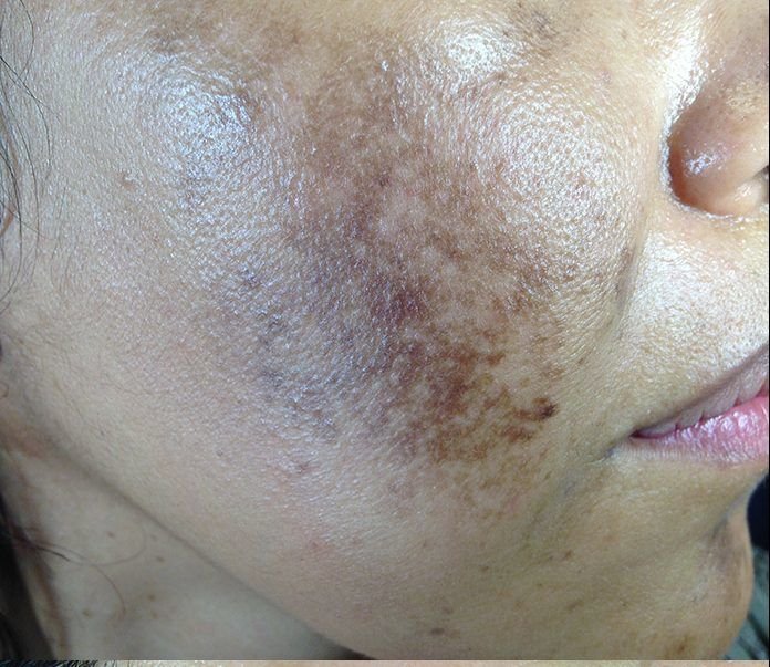 ¿Cómo eliminar las manchas en la piel?