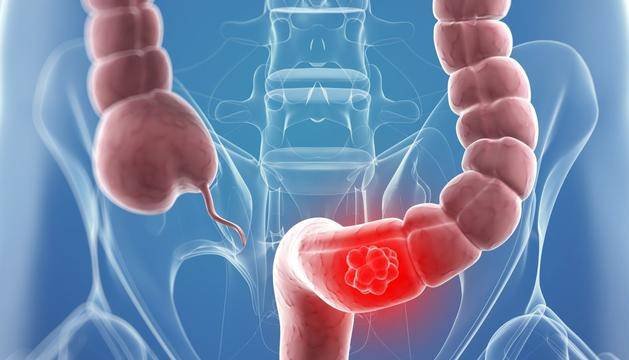 colon irritable