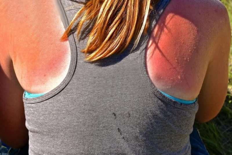 piel quemada sol
